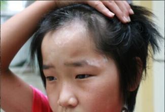导致男孩子患上白癜风原因是什么？